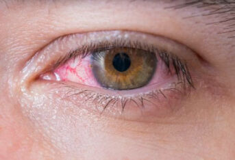 看看中医是怎么治红眼病的？