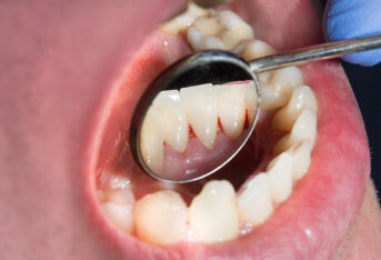 牙龈萎缩有哪危害？应该如何治疗呢？