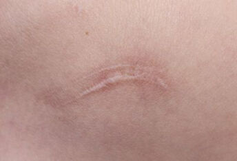 疤痕增生期常用抗疤痕方法有哪些？