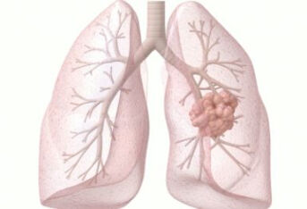 肺癌解读（一）