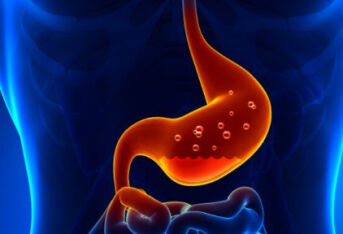 胆汁反流性胃炎需要注意什么？