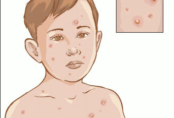 胆碱能性荨麻疹