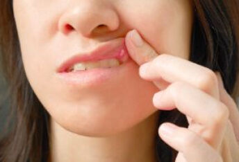 口腔溃疡怎么治，分类，治疗选择