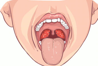 扁桃体切除术后注意事项及饮食指导