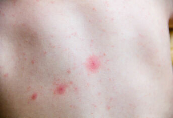 湿疹的早期症状是什么？