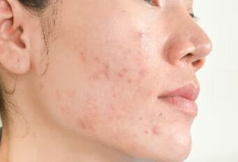 面部瘢痕疙瘩的同位素敷贴治疗需考虑美容需求