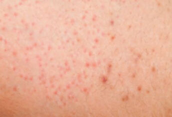 什么是皮炎湿疹？它们是一回事吗