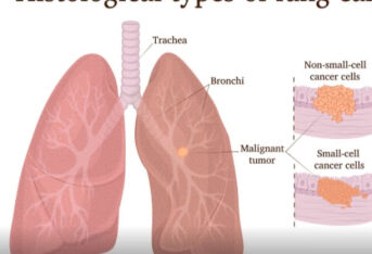 小细胞肺癌早期的症状表现有哪些？