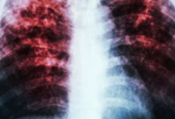肺癌到底会有什么症状？只是咳嗽吗？
