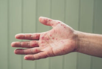 手足口病斑丘疹怎么治疗？