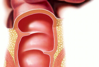肛窦炎是如何诱发其它肛肠疾病的？