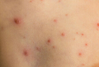 幼儿急疹皮疹的日常护理注意事项有哪些？