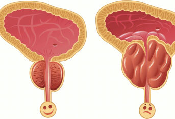 前列腺增生三大阶段 
