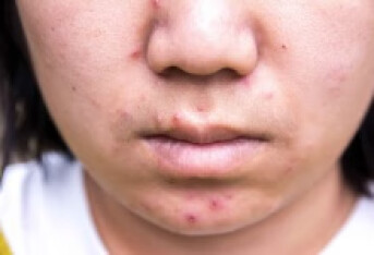 毛囊炎疤痕用什么药 涂抹2种药能消除皮肤疤痕