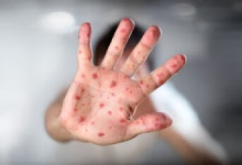 出麻疹能吹空调吗 出麻疹的禁忌事项告诉你