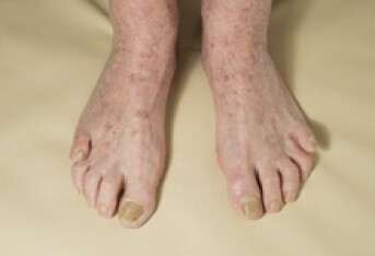 灰指甲有几种症状   尽早发现病情