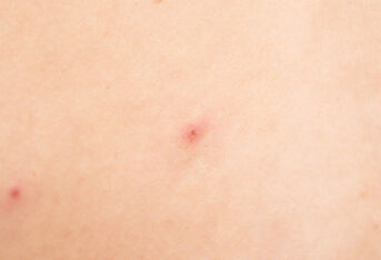 湿疹患者如何日常预防？