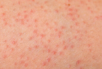 湿疹恢复后皮肤怎样护理？