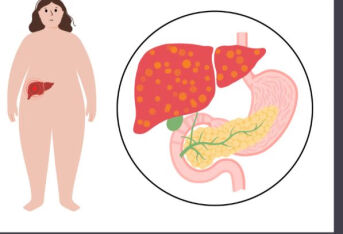 脂肪肝健康教育