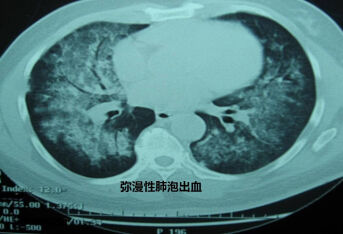 系统性红斑狼疮合并弥漫性肺泡出血