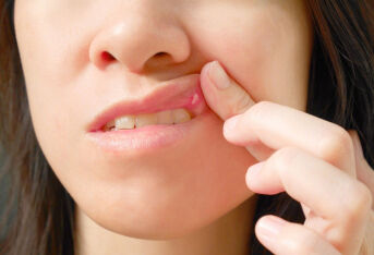 口腔疱疹如何治疗？