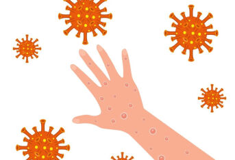六地已确诊10例猴痘病例！普通人会感染吗？是否应该引起警惕？