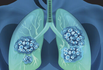 肺癌KRAS基因G12D突变有什么有效的药？