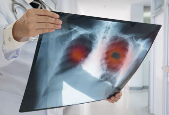 肺癌患者合并肺栓塞该怎么办？