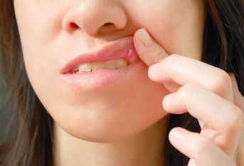 经期引起的口腔溃疡怎么治？