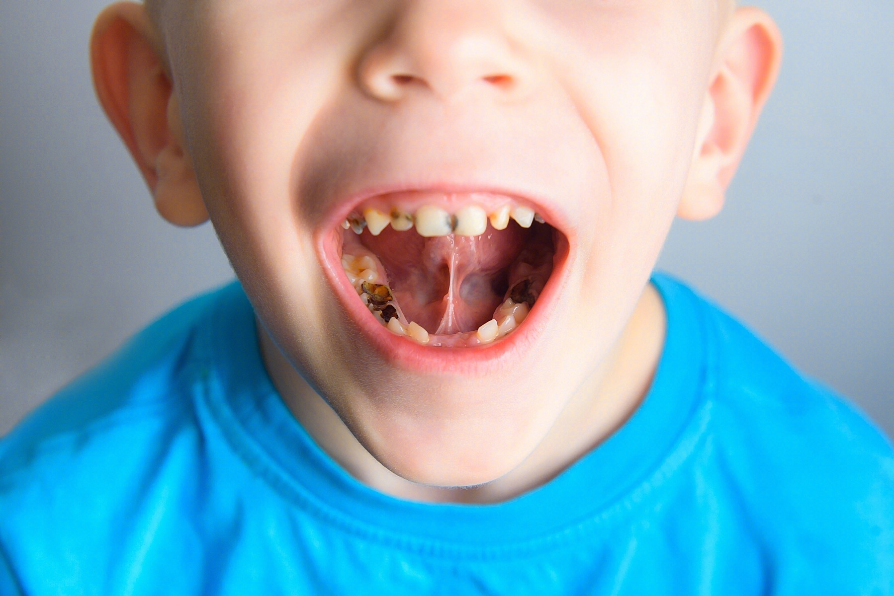 幼儿龋齿没必要补牙是真的吗？ | 升艺口腔医院