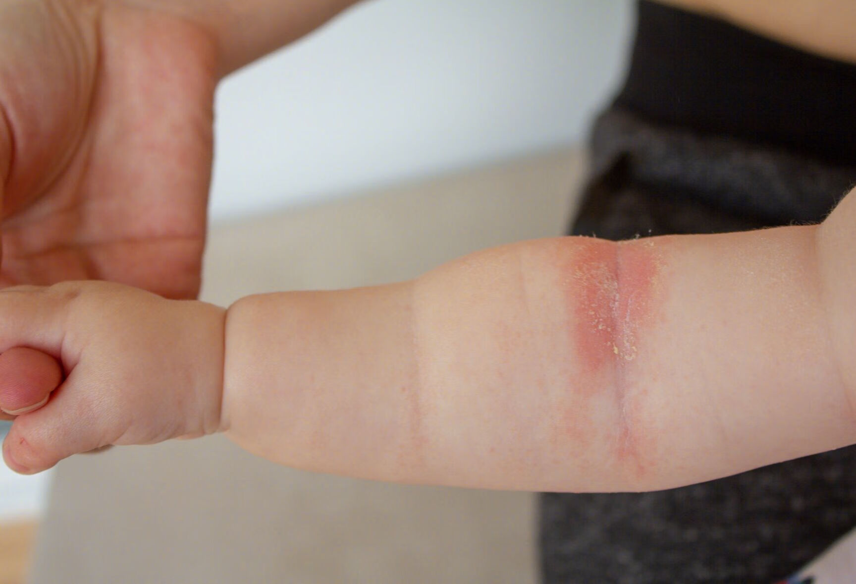 手背部和腕部起疹子，双手都有，呈蔓延趋势是什么原因起疹子？是过敏还是皮炎？要怎么用药能缓解？- 京东健康