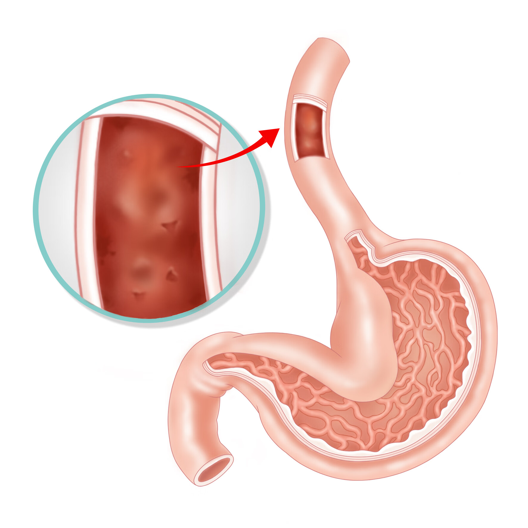 食道癌忌口什么-京东健康