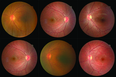 眼底黄斑变性眼底出血怎么办_概述_黄斑变性