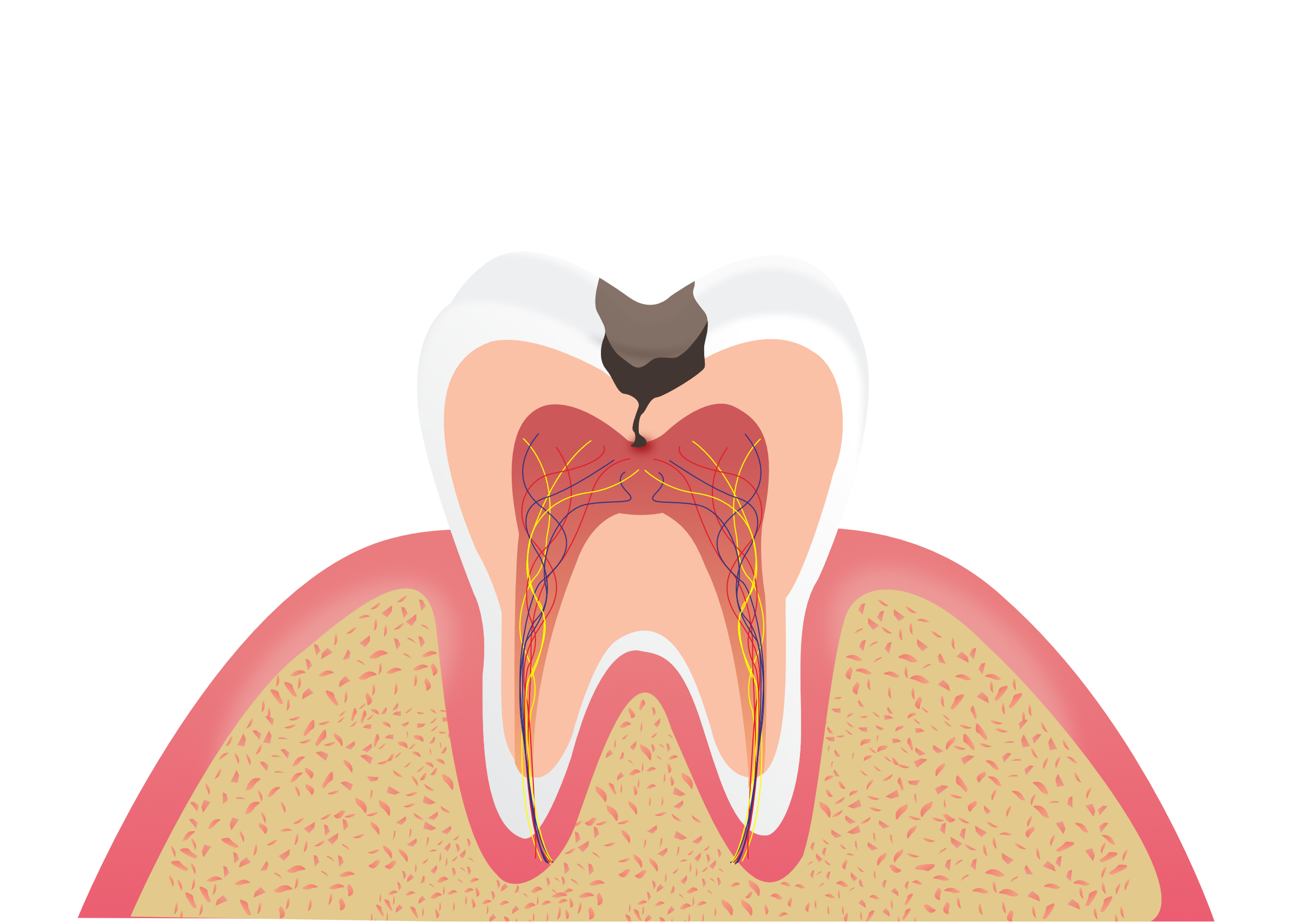 别让牙齿走不归路！牙龈发炎8大原因一定要知道 | 牙龈炎 | 牙周病 | 预防 | 大纪元