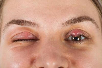 病毒性结膜炎眼睛一定会痒吗-京东健康