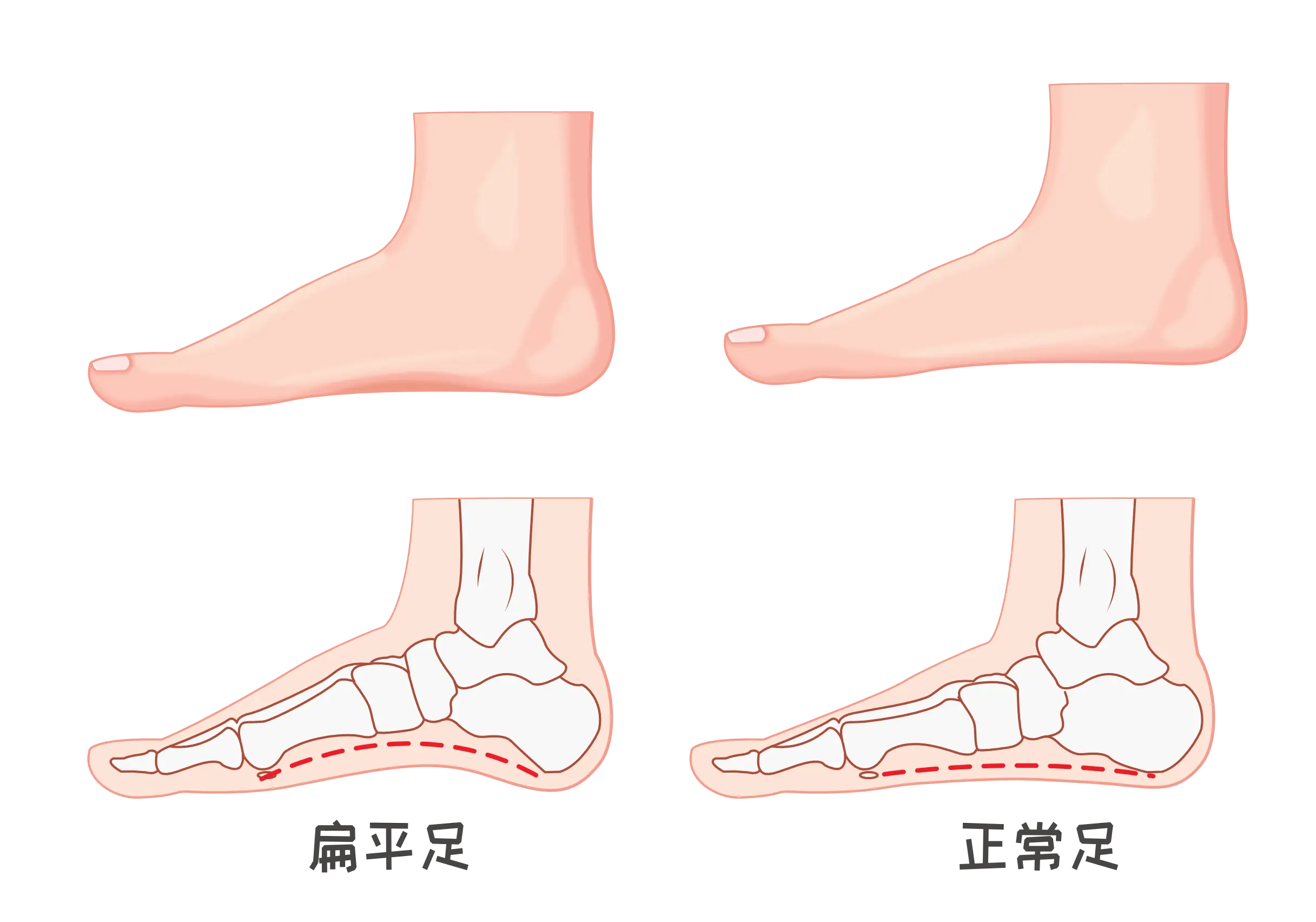 神 穿凉鞋也能穿出皮肤癌