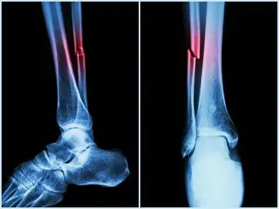 左腿胫腓骨骨折怎么办左腿胫腓骨骨折四个处理方法详述