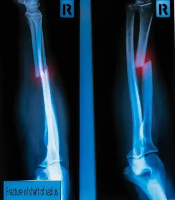 胫腓骨骨折如何固定