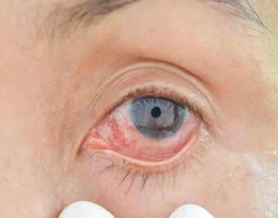 角膜云翳的去除方法有哪些-京东健康