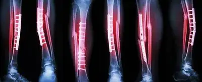 胫腓骨骨折如何恢复了解胫腓骨骨折的康复方法